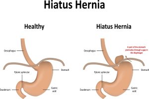 4 Lesser Known Facts About Hiatal Hernia - DFW Bariatrics and General ...